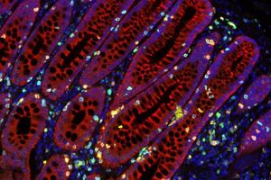 کشف نقشه‌ راه برای غلبه بر سرطان روده