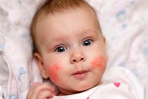 بلایی که کمبود این ویتامین سر پوست کودکان می‌آورد