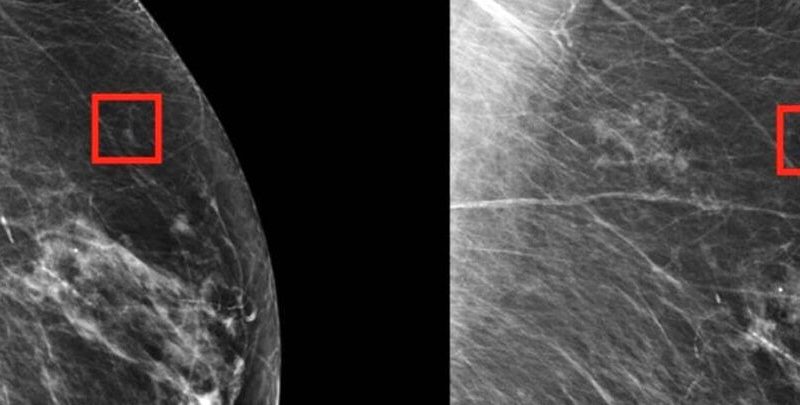 هوش مصنوعی و اثری باورنکردنی در تشخیص سرطان سینه