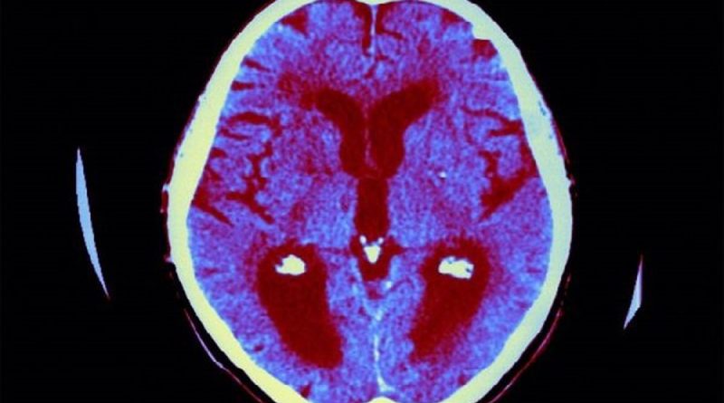 فراموشی زودهنگام در کودکان؛ یک دلیل خطرناک