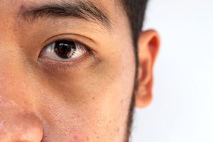 «چشم پاندایی» چیست؟