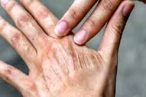 چگونه از خشکی پوست در پاییز جلوگیری کنیم؟